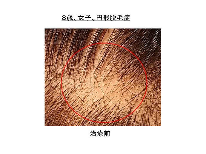 円形脱毛症　病院""